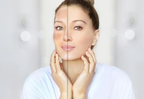 Piel Sensible y Frío: Calma Rojeces e Irritación en la Montaña 🌿